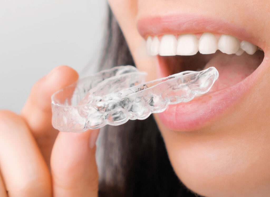 Aligners - Gebitzorgcentrum
