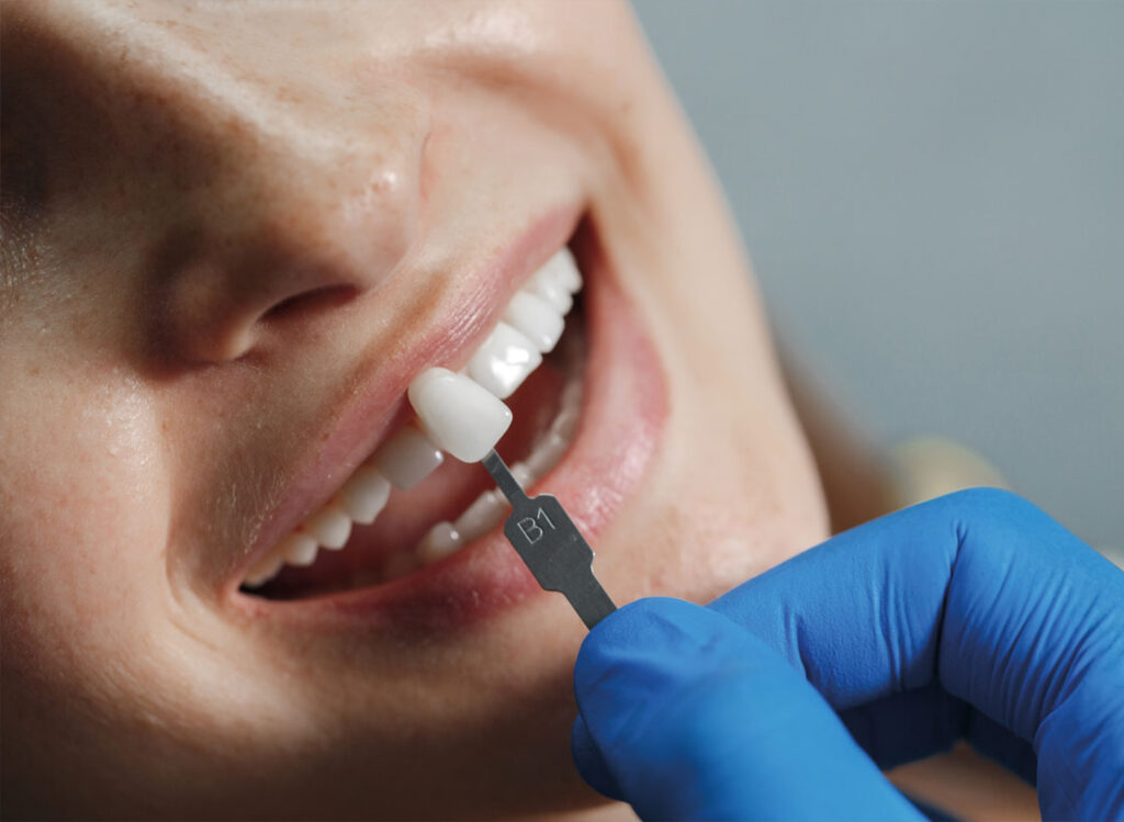 Facing/veneers - Gebitzorgcentrum