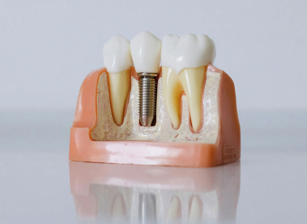 Implantaatprothese - Gebitzorgcentrum