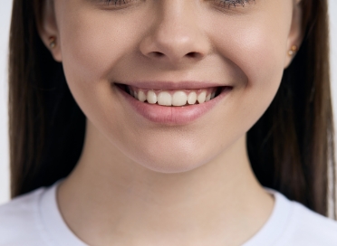 Tanden bleken - Gebitzorgcentrum